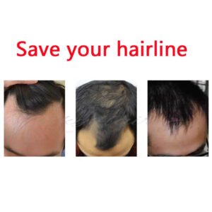 Wovana Hair โ Best Hair Wig & Patch 100% Human Hair Original